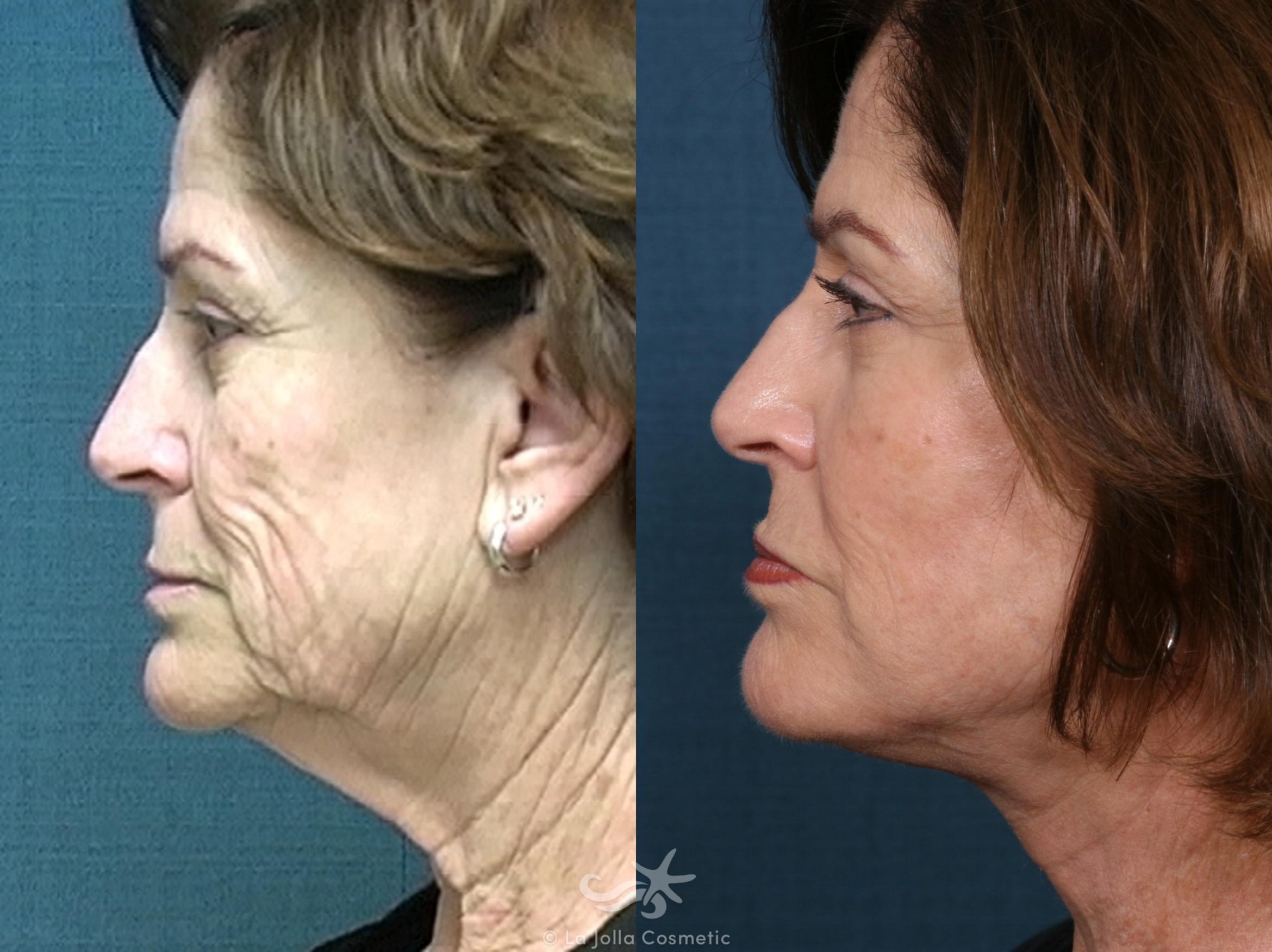 Before & After Facelift Result 513 Left Side View in San Diego, CA