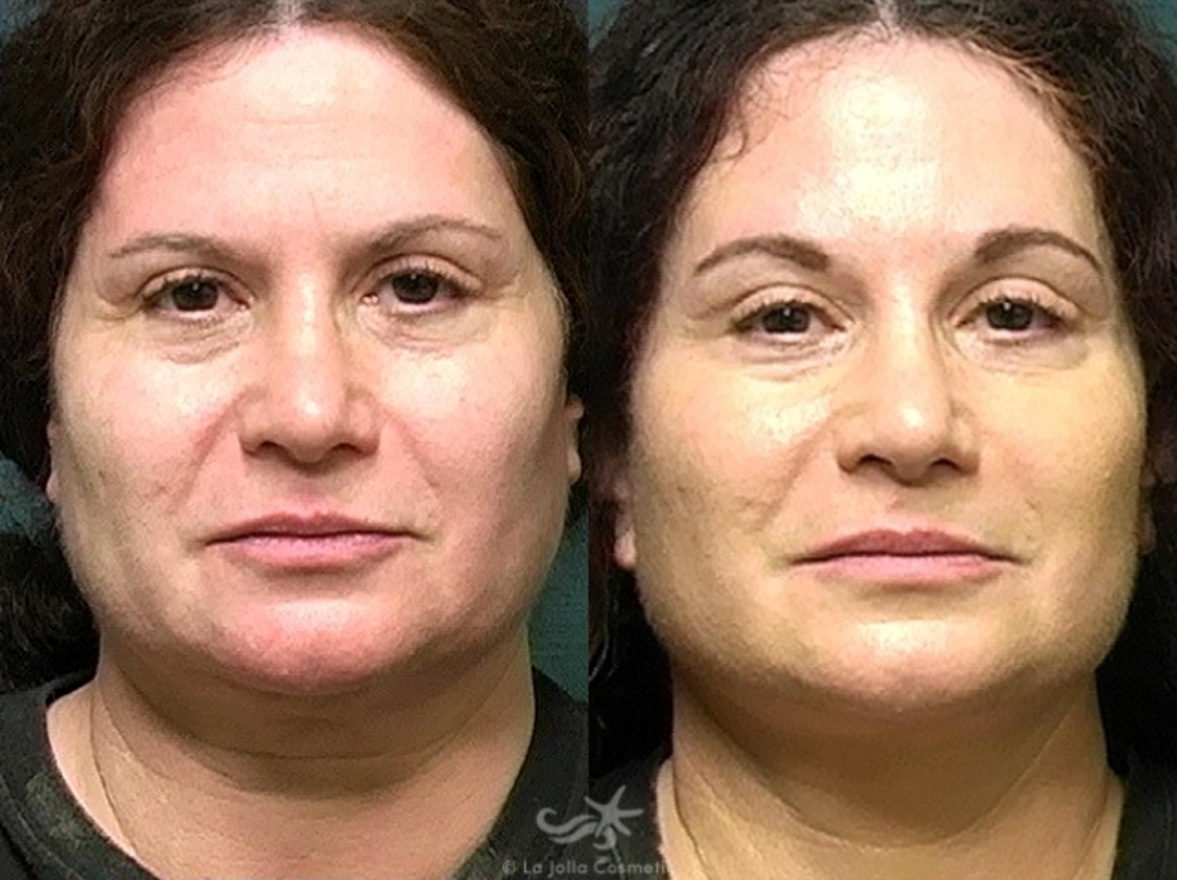 Before & After Eyelid Lift Result 528 Front View in San Diego, CA