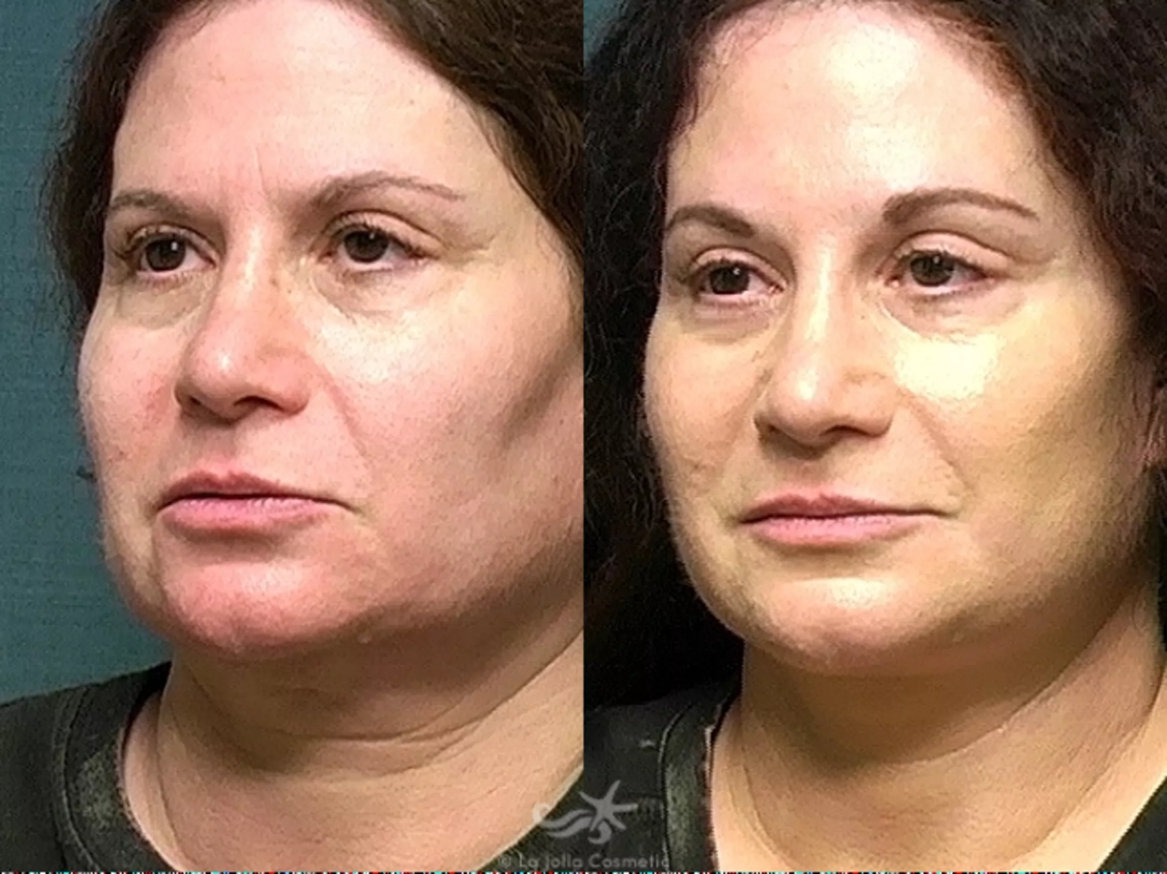 Before & After Facelift Result 528 Left Oblique View in San Diego, CA