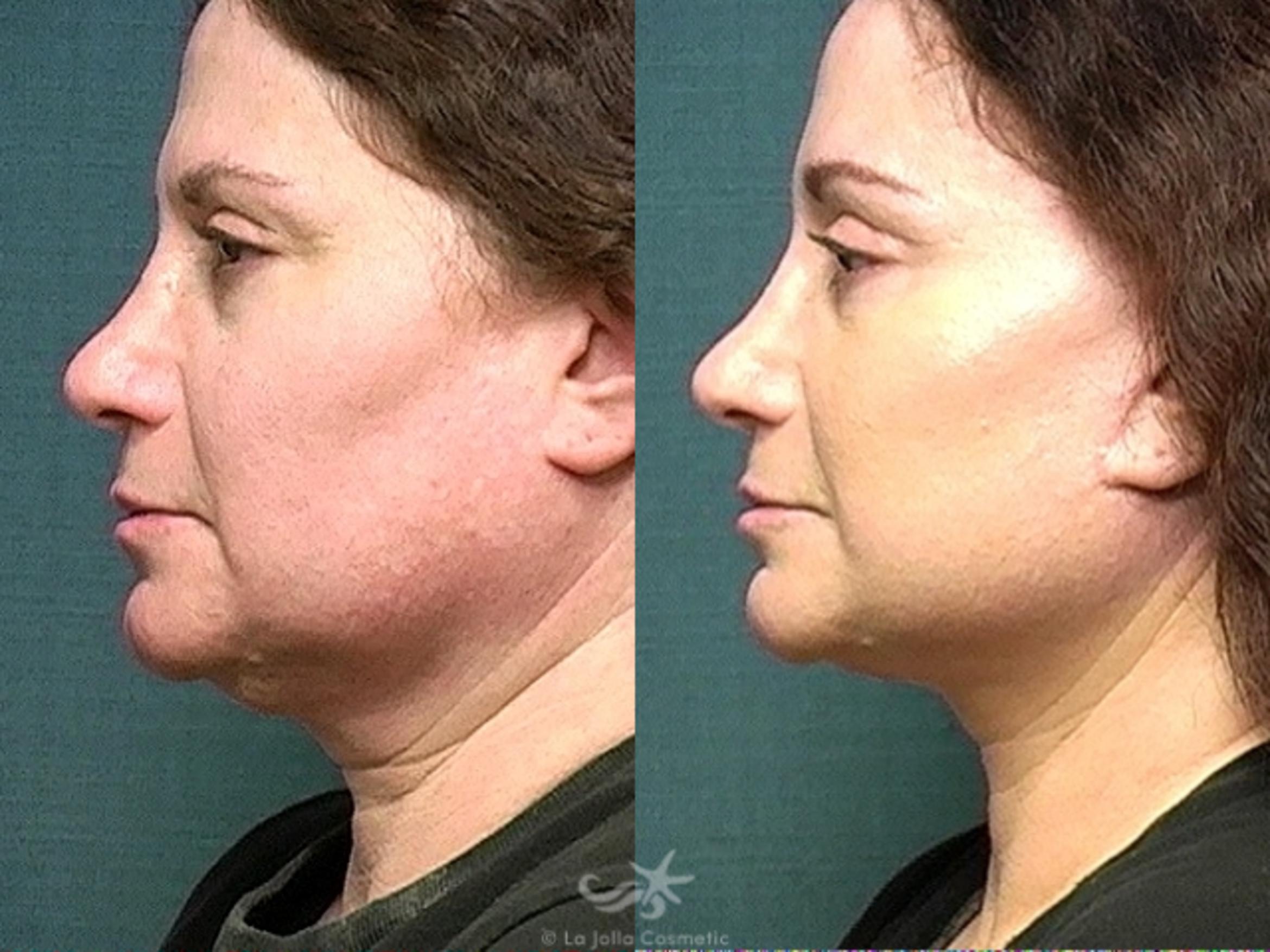 Before & After Facelift Result 528 Left Side View in San Diego, CA