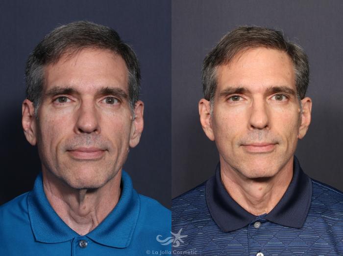 Before & After Facelift Result 56 Front View in San Diego, Carlsbad, CA