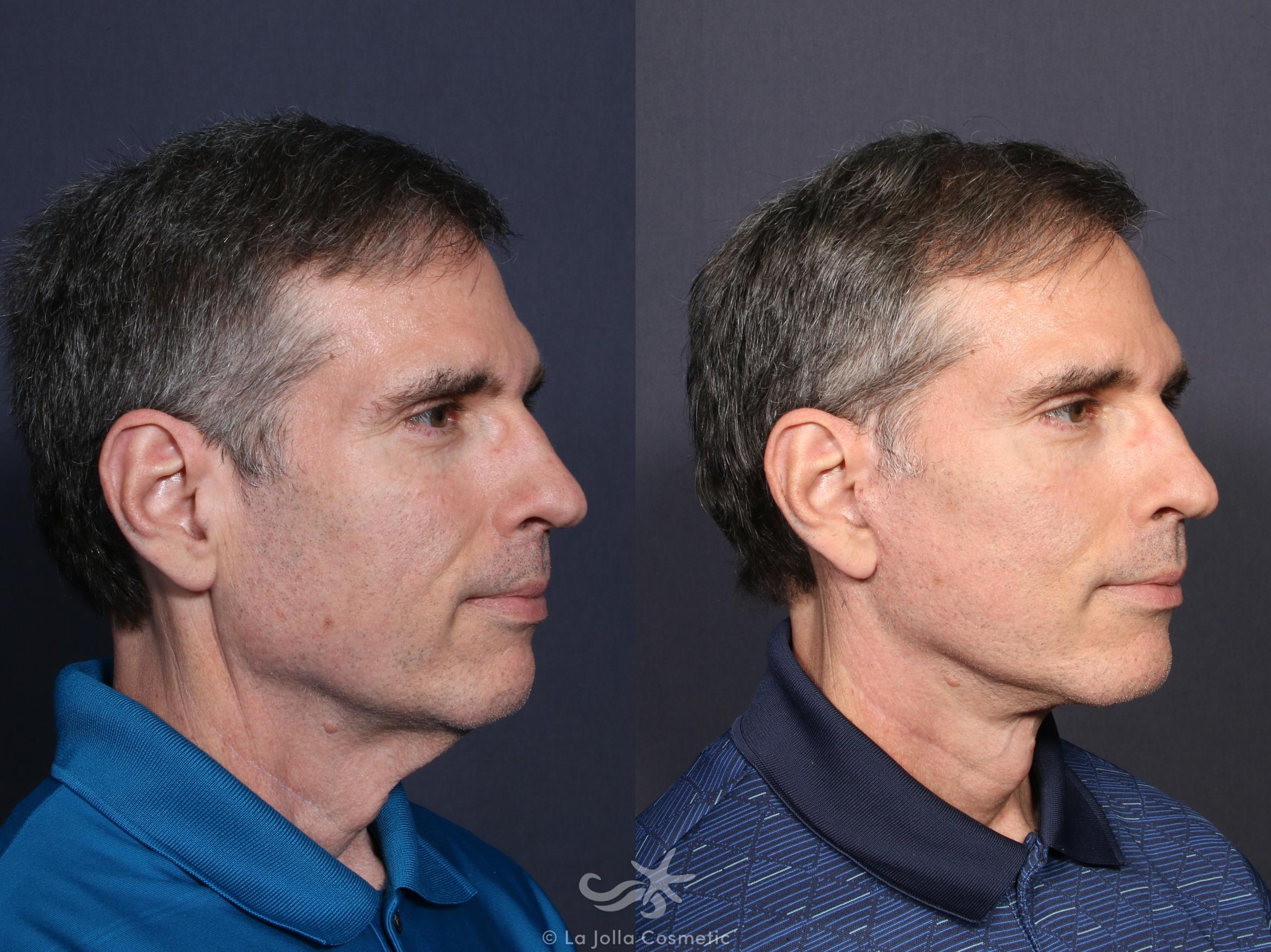 Before & After Facelift Result 56 Right Oblique View in San Diego, CA
