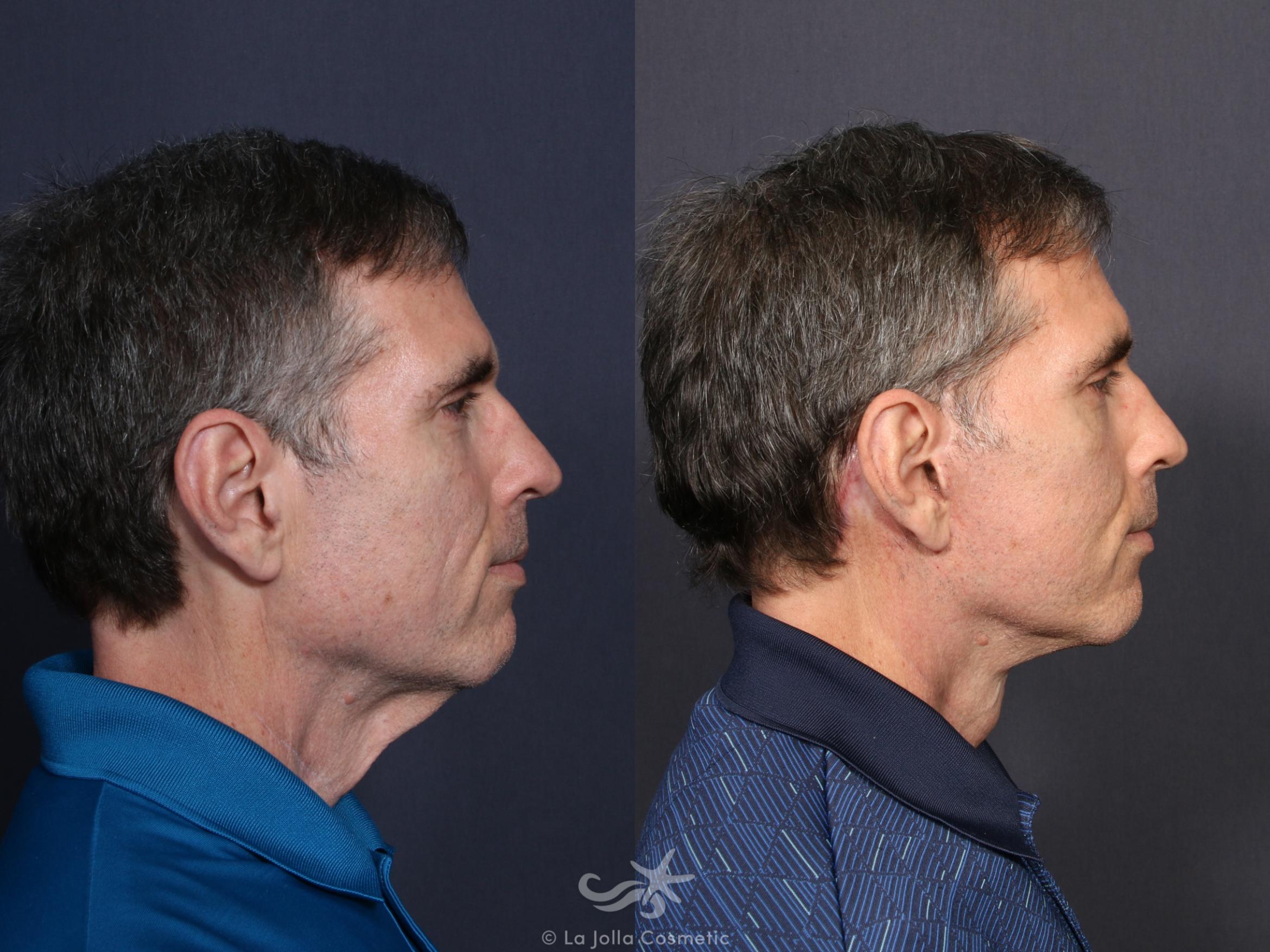 Before & After Facelift Result 56 Right Side View in San Diego, CA