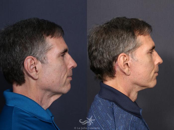 Before & After Facelift Result 56 Right Side View in San Diego, Carlsbad, CA