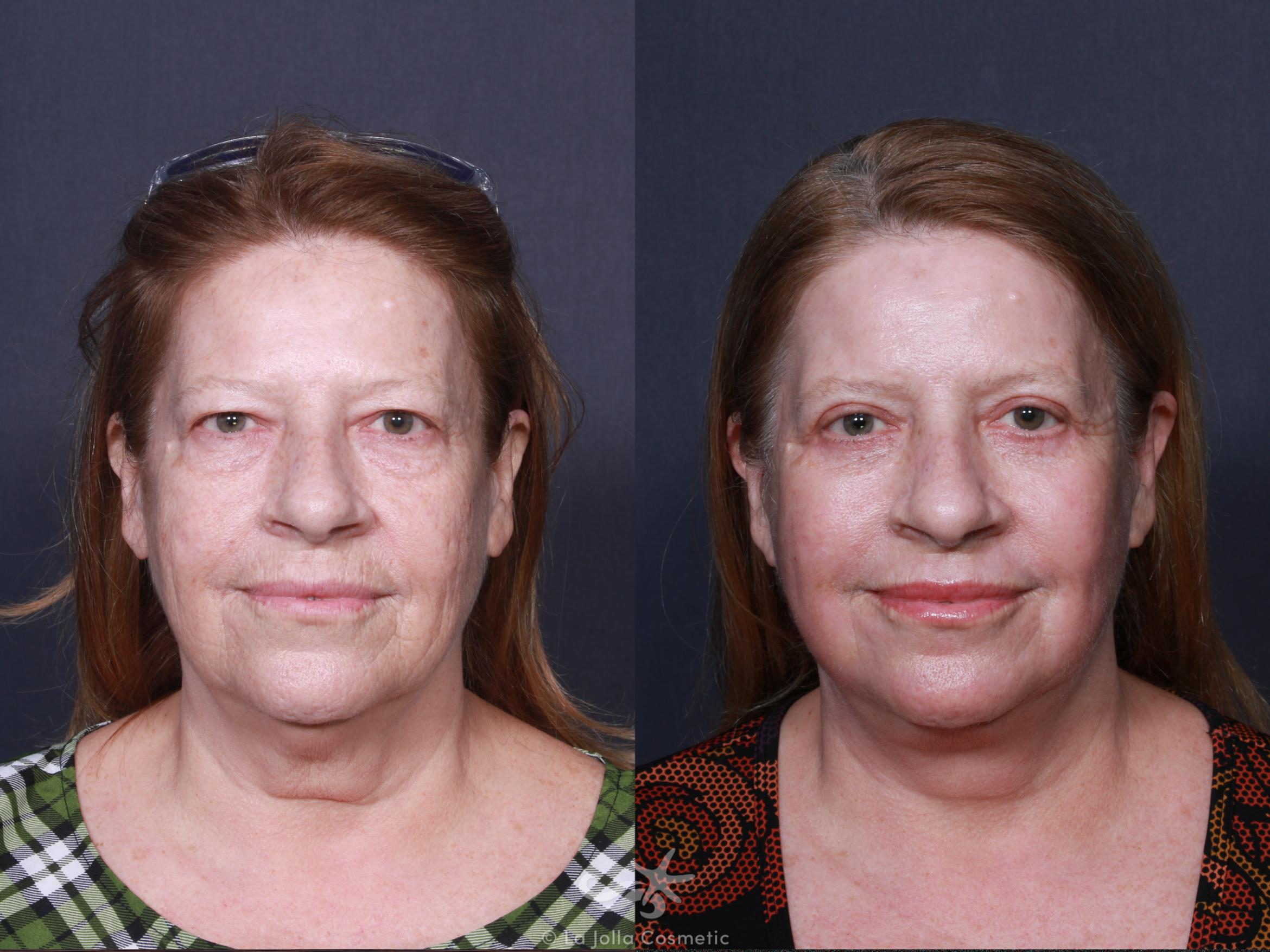 Before & After Facelift Result 566 Front View in San Diego, CA