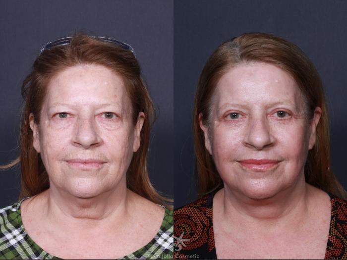 Before & After Facelift Result 566 Front View in San Diego, Carlsbad, CA