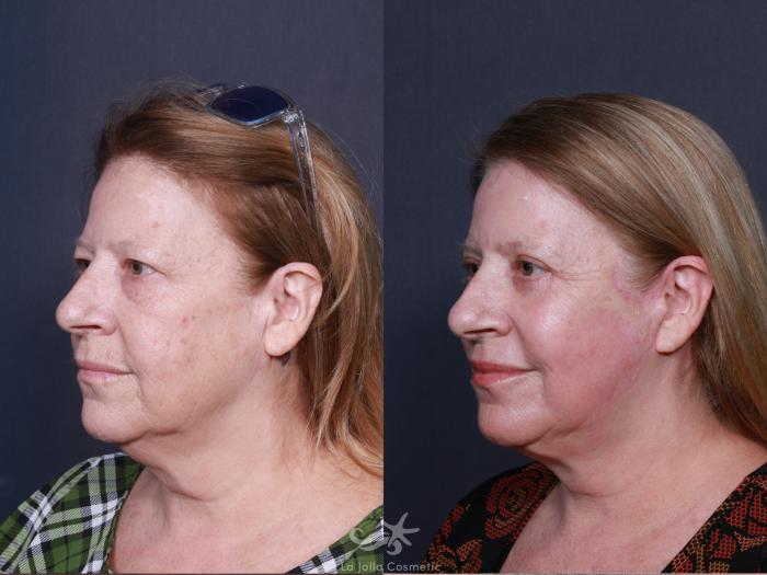 Before & After Facelift Result 566 Left Oblique View in San Diego, Carlsbad, CA