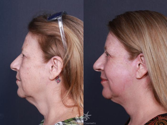 Before & After Facelift Result 566 Left Side View in San Diego, Carlsbad, CA