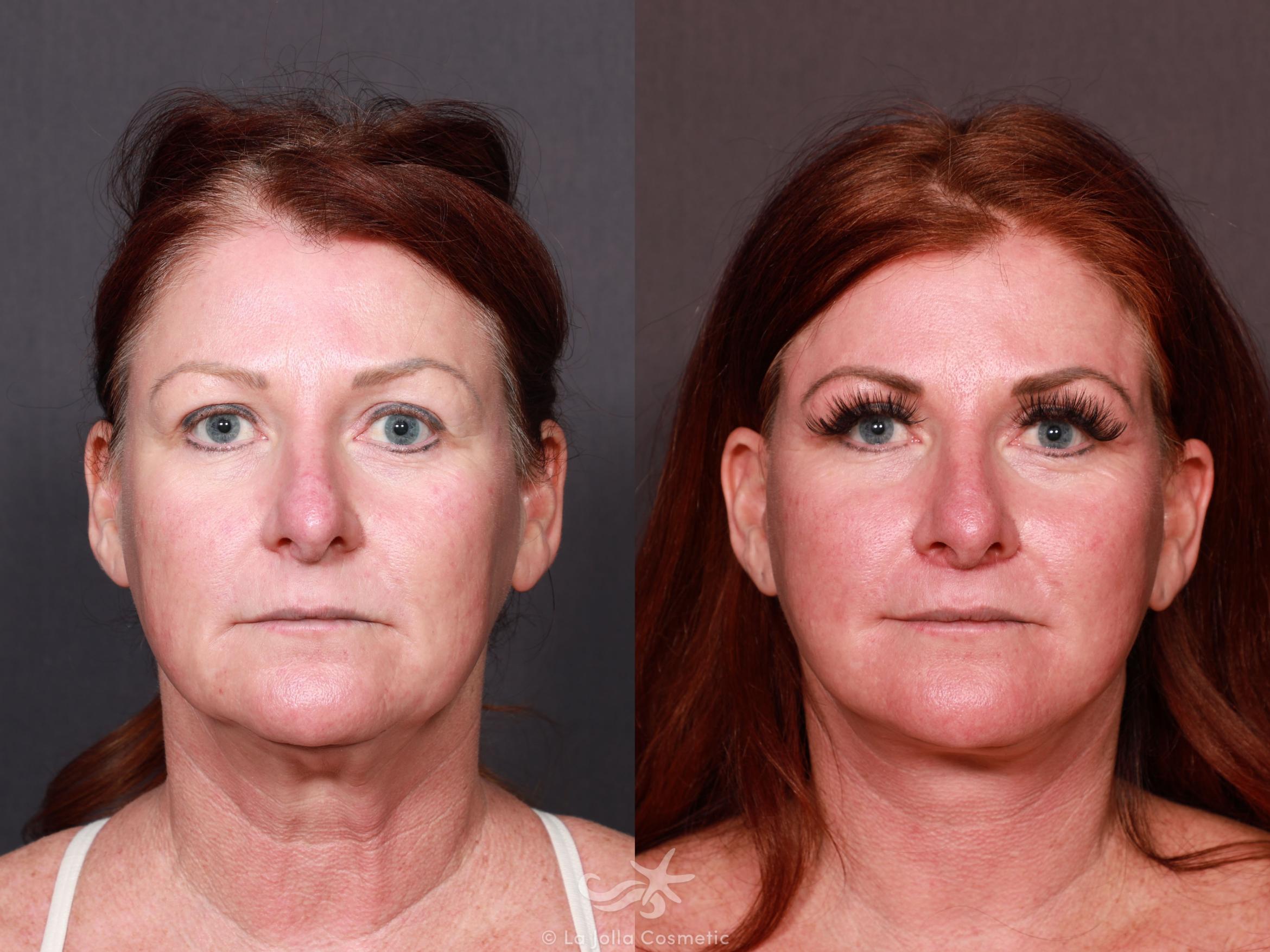 Before & After Facelift Result 623 Front View in San Diego, CA