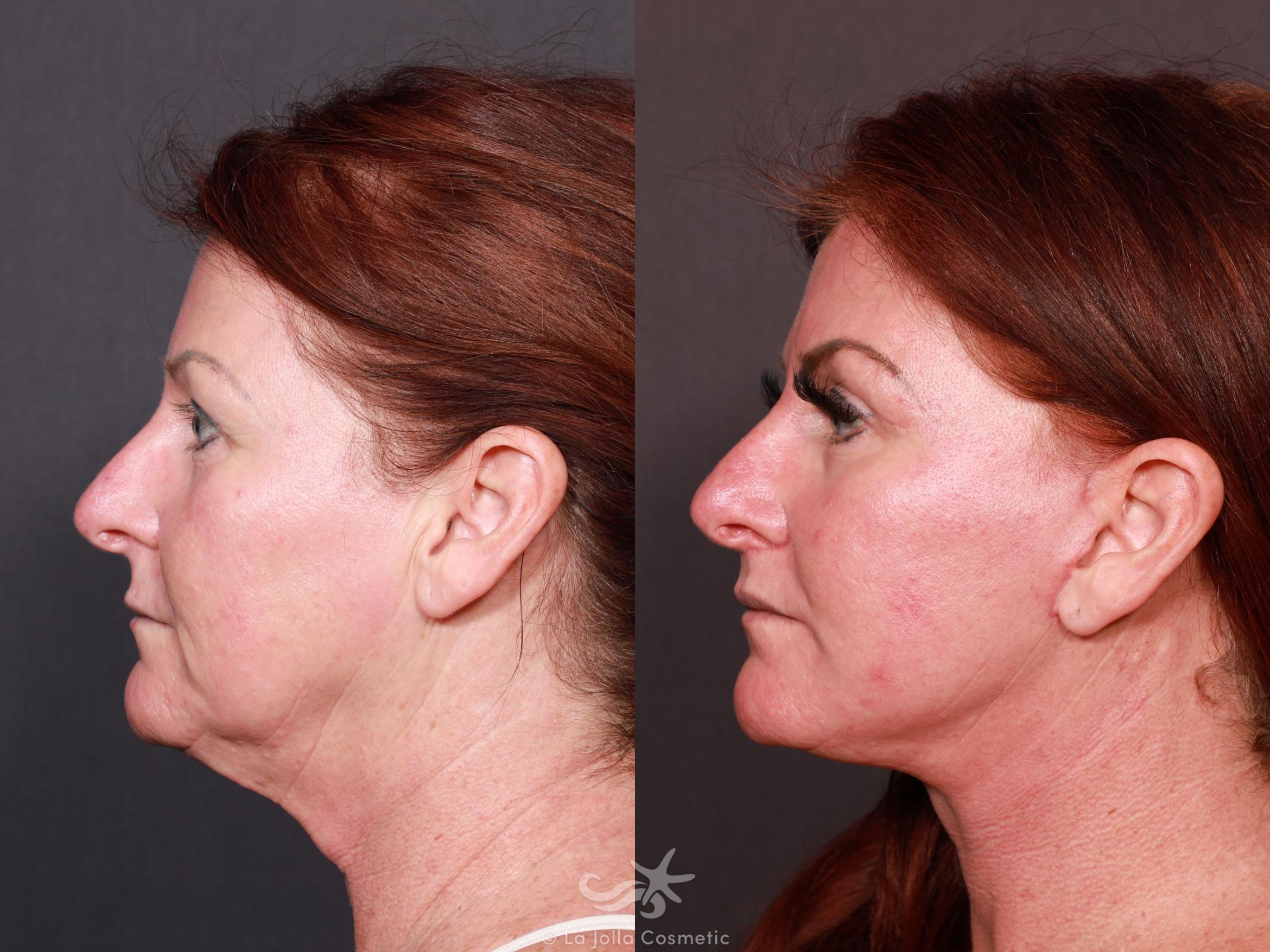 Before & After Facelift Result 623 Left Side View in San Diego, CA