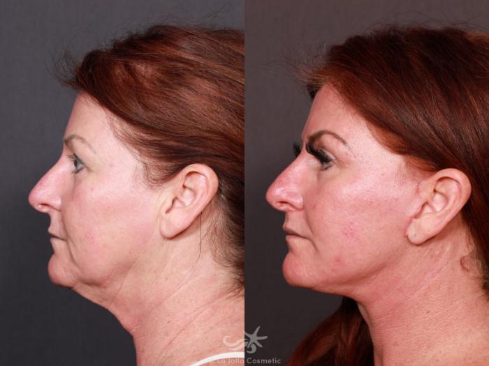 Before & After Facelift Result 623 Left Side View in San Diego, Carlsbad, CA