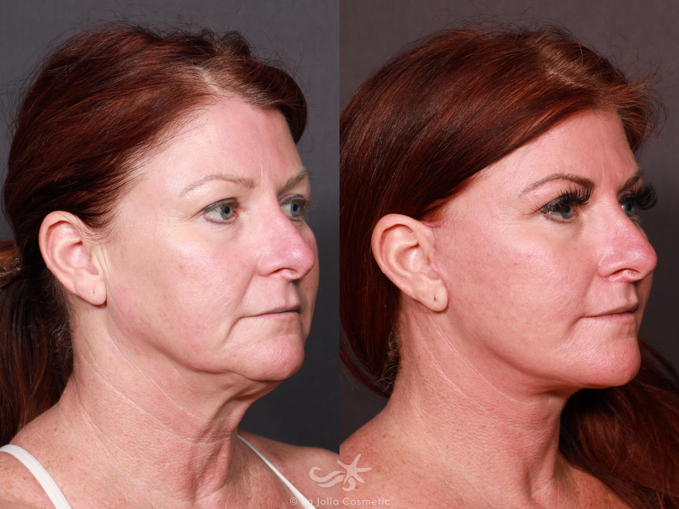 Before & After Facelift Result 623 Right Oblique View in San Diego, CA