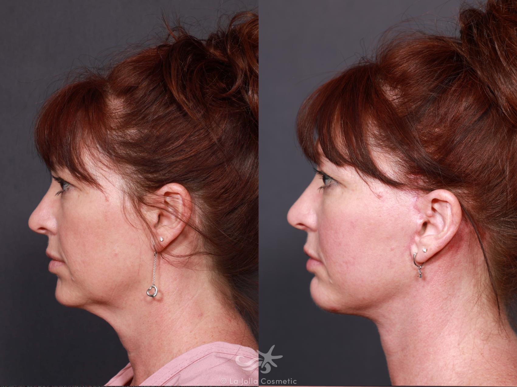 Before & After Facial Fat Transfer Result 624 Left Side View in San Diego, CA