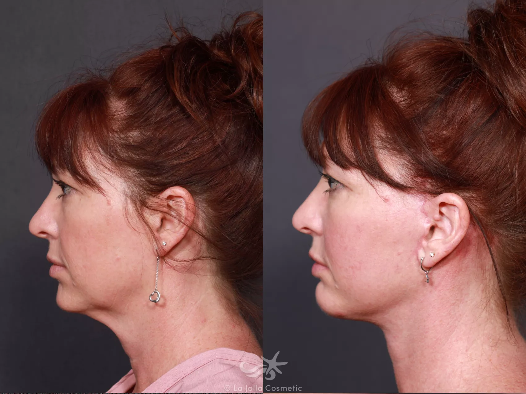 Before & After Rhinoplasty Result 624 Left Side View in San Diego, CA