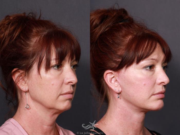 Before & After Facelift Result 624 Right Oblique View in San Diego, Carlsbad, CA