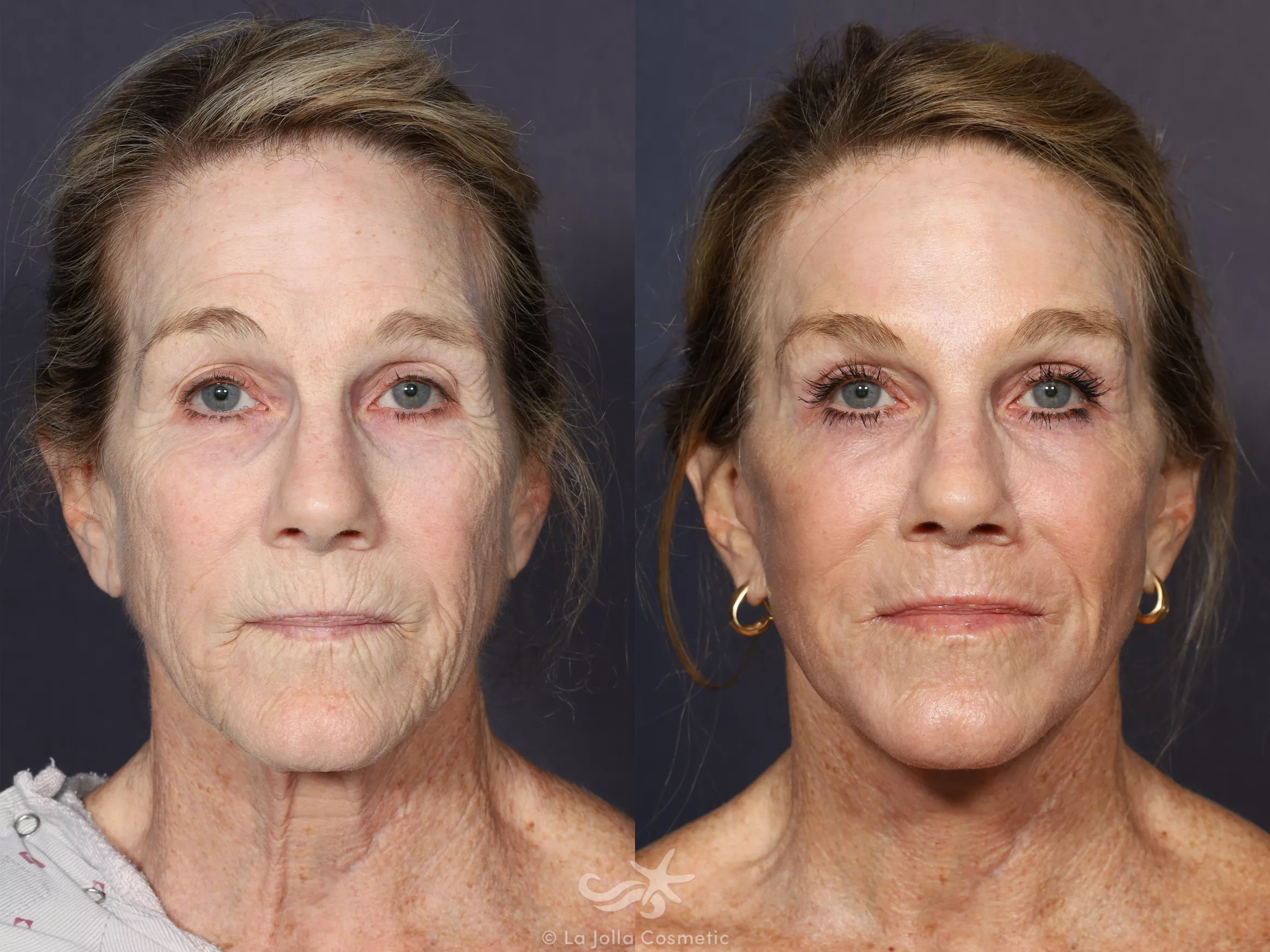 Before & After Facelift Result 664 Front View in San Diego, CA