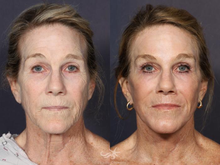Before & After Facelift Result 664 Front View in San Diego, Carlsbad, CA