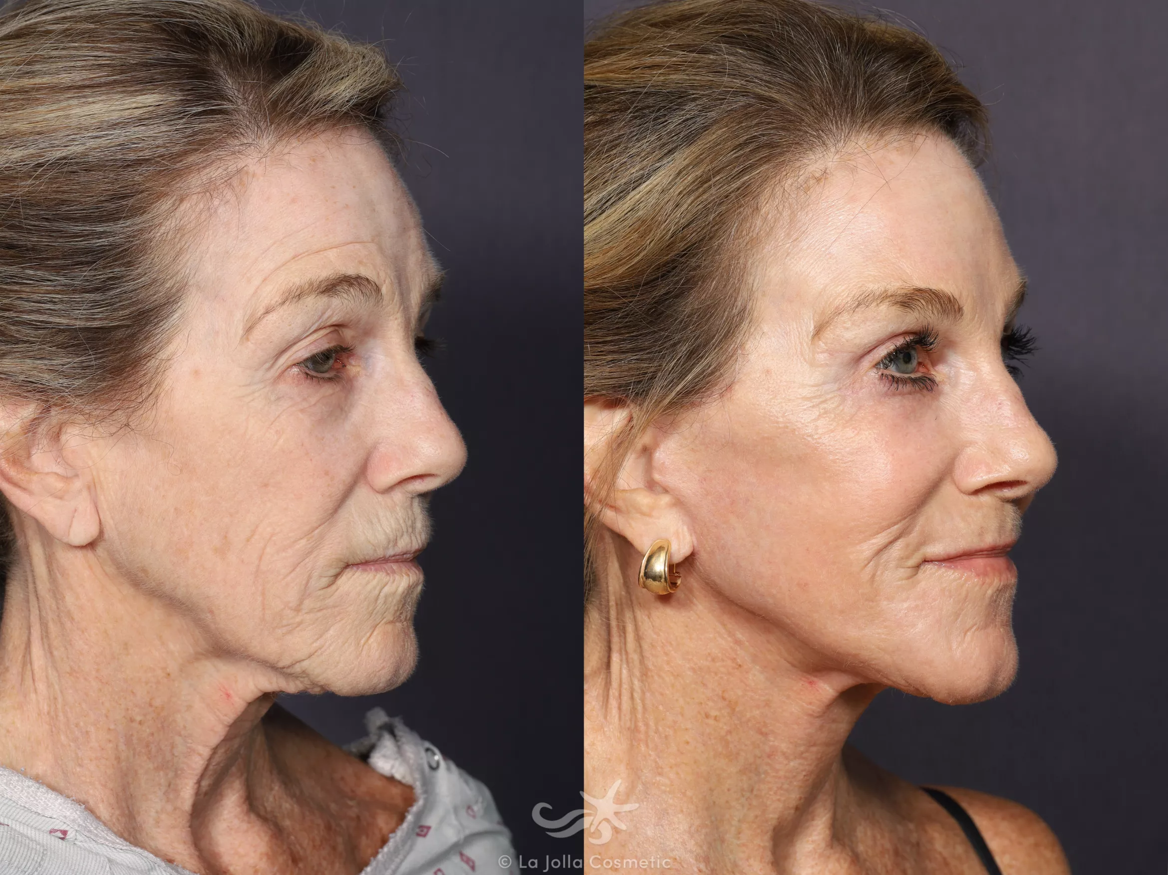 Before & After Facelift Result 664 Right Oblique View in San Diego, CA