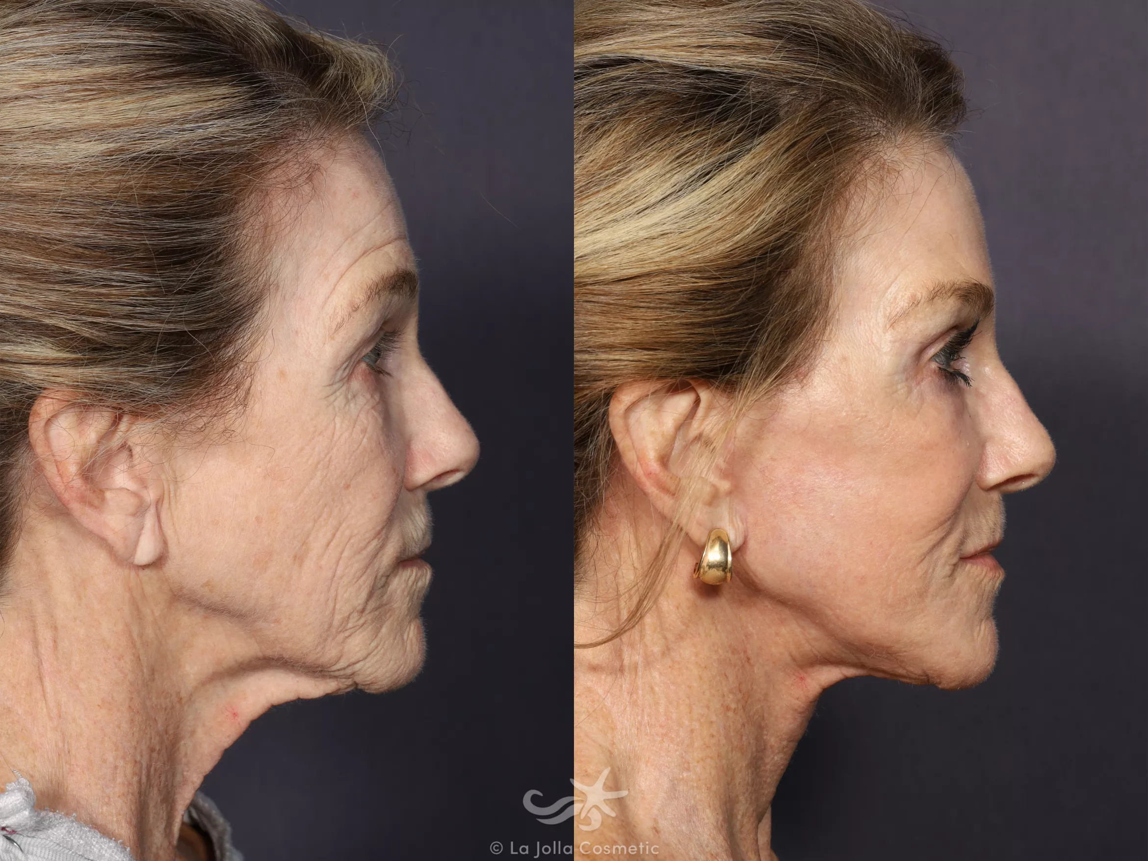 Before & After Facelift Result 664 Right Side View in San Diego, CA