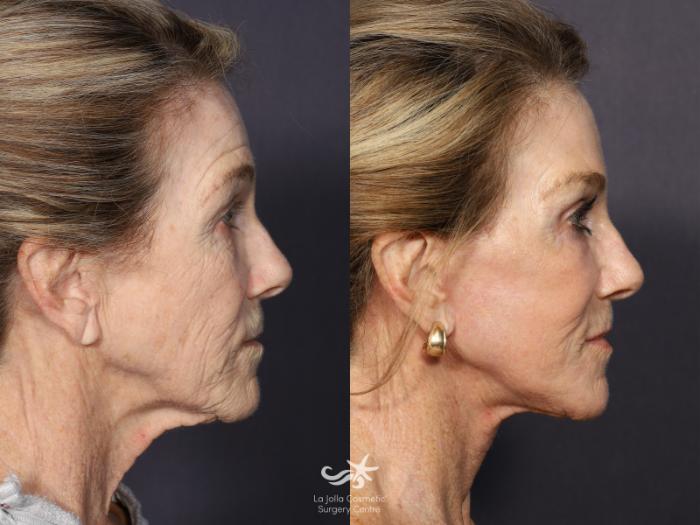 Neck Lift Before and After Photo Gallery | San Diego, CA Neck Lift Before and After Photo Gallery | San Diego, CA