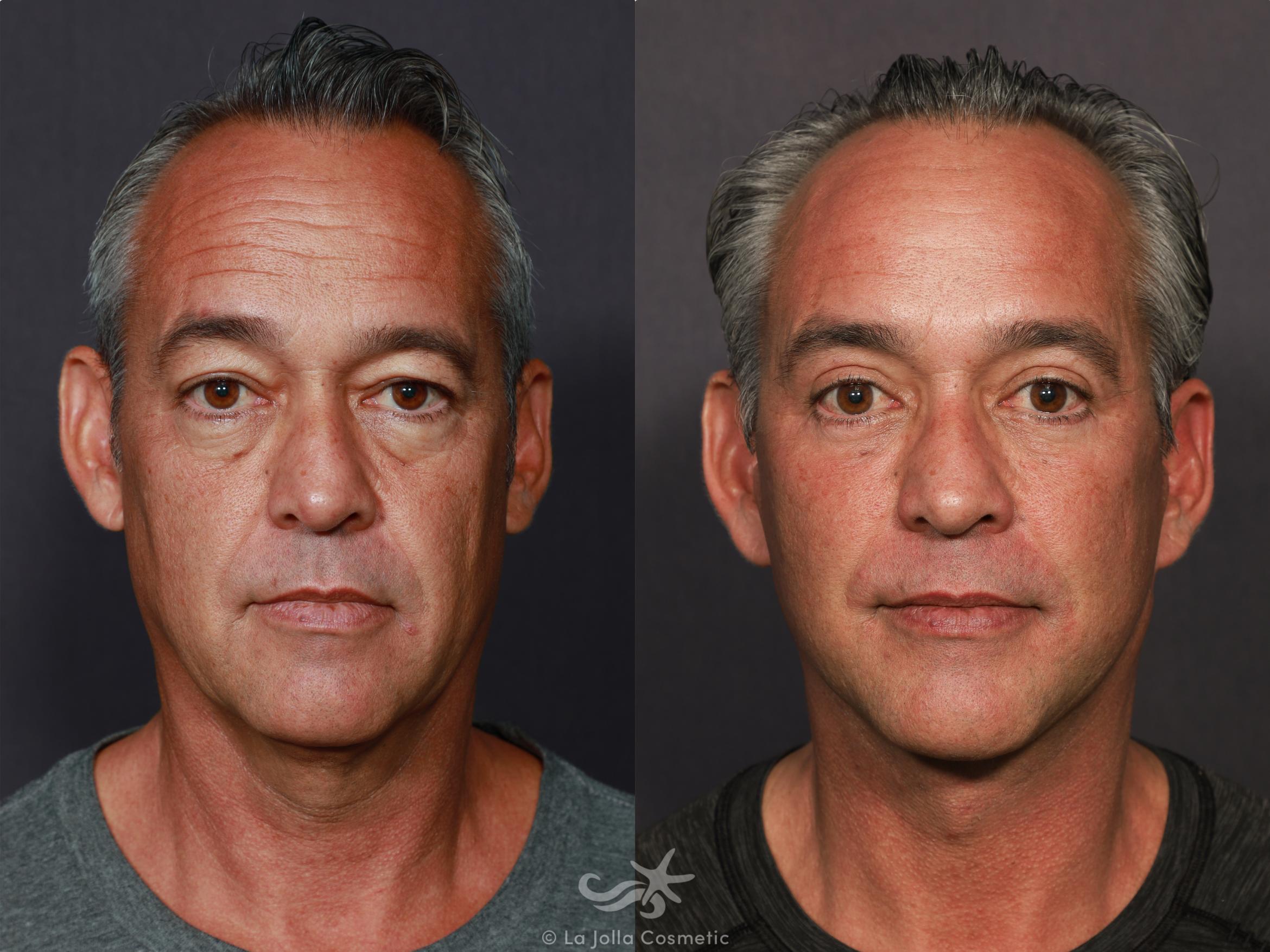 Before & After Facelift Result 713 Front View in San Diego, CA