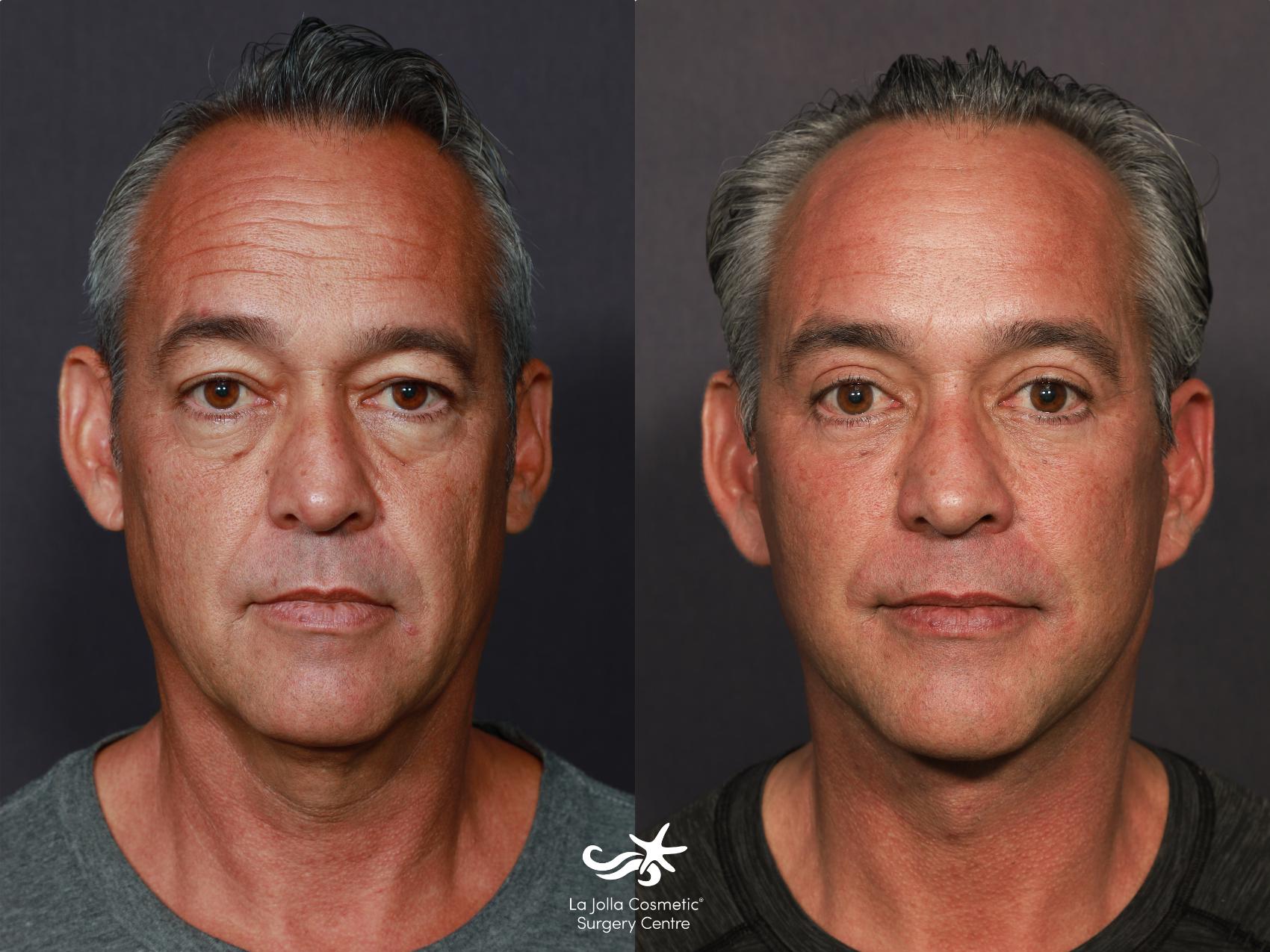 Before & After Facelift Result 713 Front View in San Diego, CA