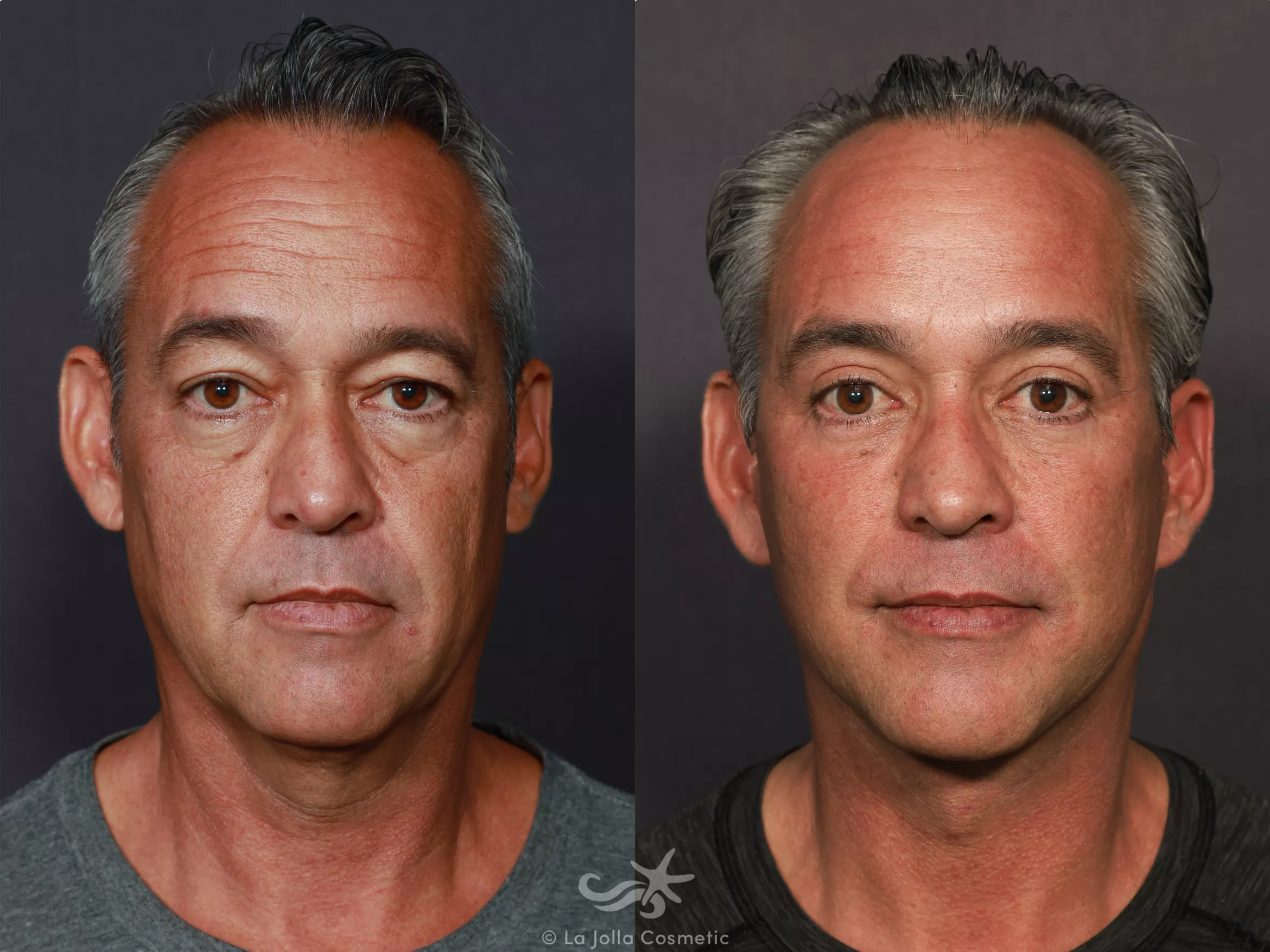 Before & After Eyelid Lift Result 713 Front View in San Diego, CA