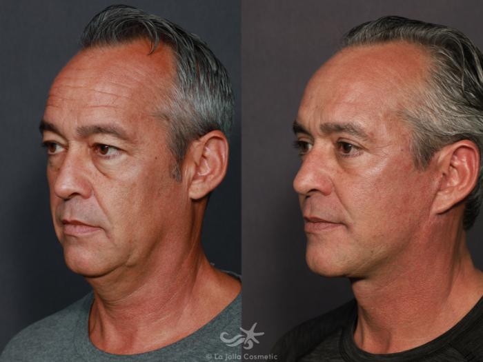 Before & After Facelift Result 713 Left Oblique View in San Diego, Carlsbad, CA