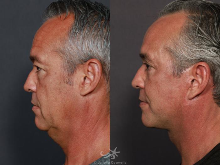 Before & After Facelift Result 713 Left Side View in San Diego, Carlsbad, CA