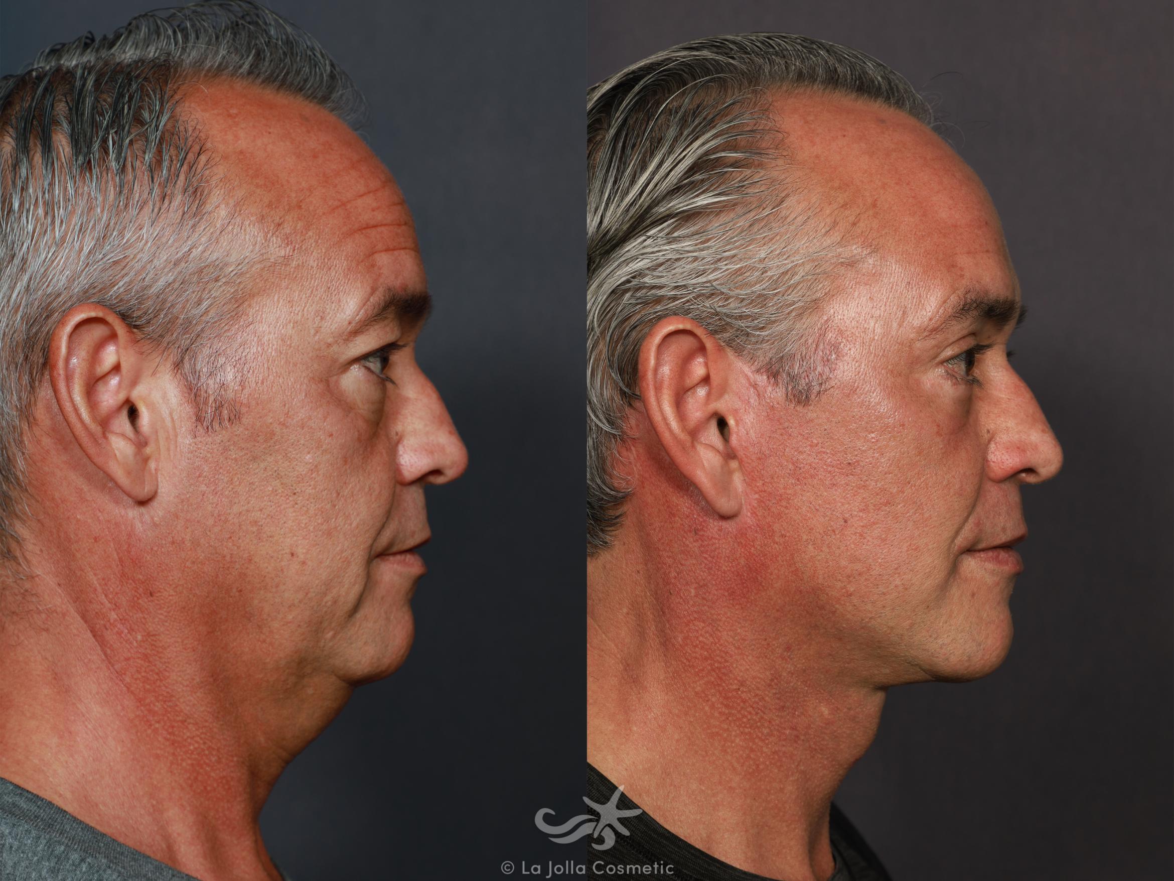 Before & After Facelift Result 713 Right Side View in San Diego, CA