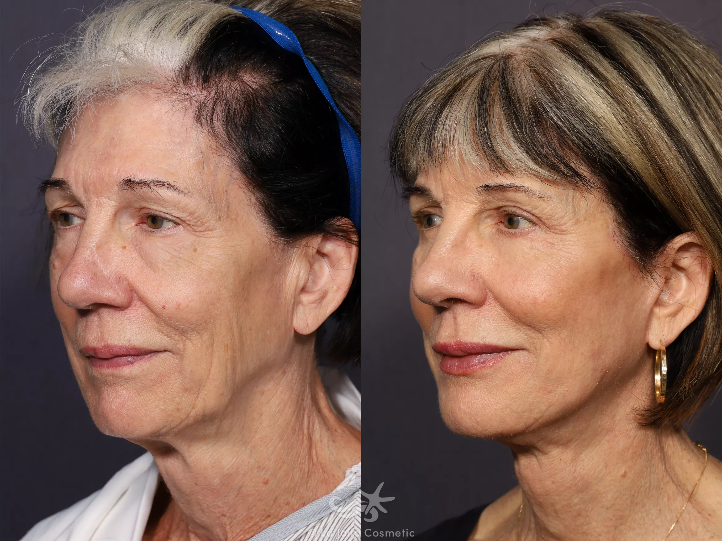 Before & After Facelift Result 722 Left Oblique View in San Diego, CA