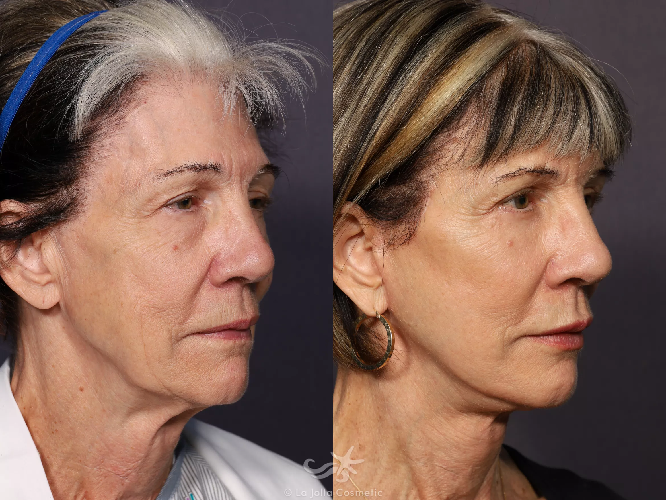 Before & After Facelift Result 722 Right Oblique View in San Diego, CA