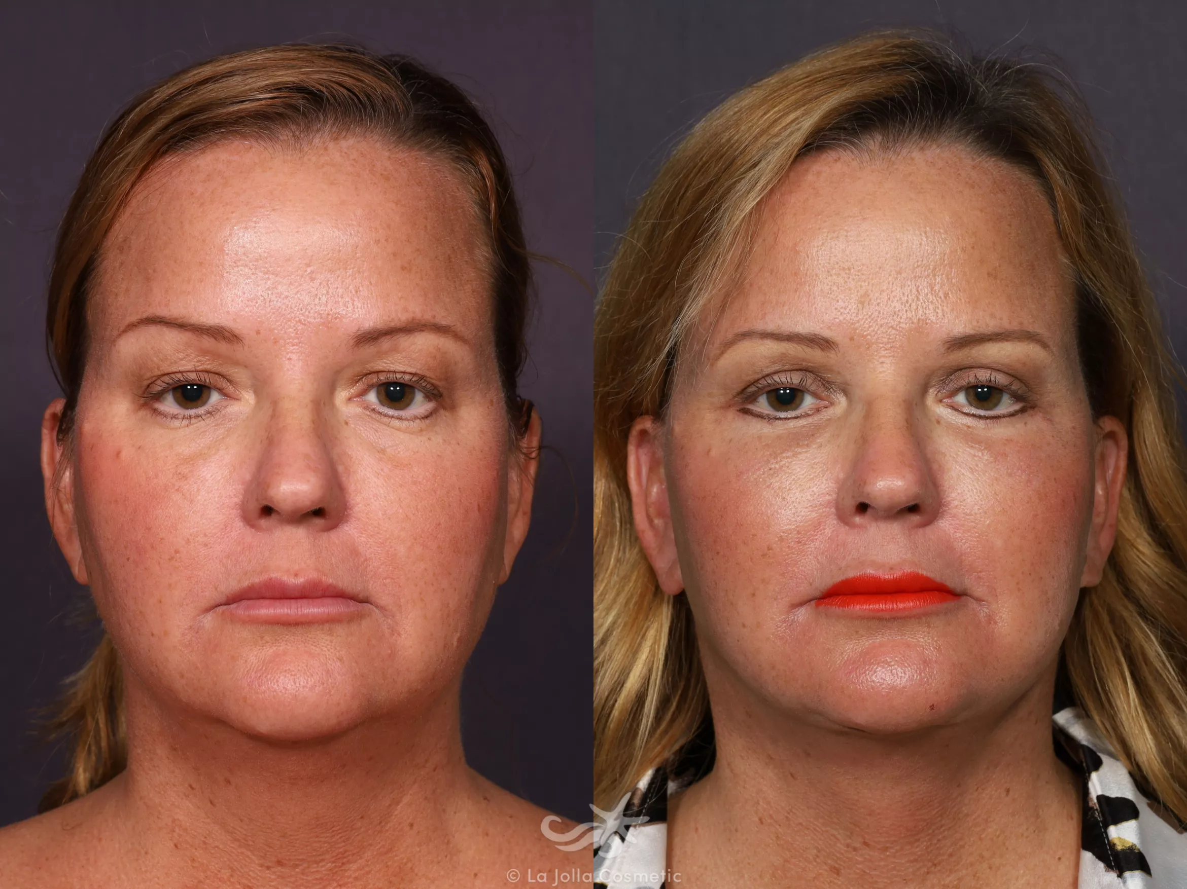 Before & After Facelift Result 725 Front View in San Diego, CA