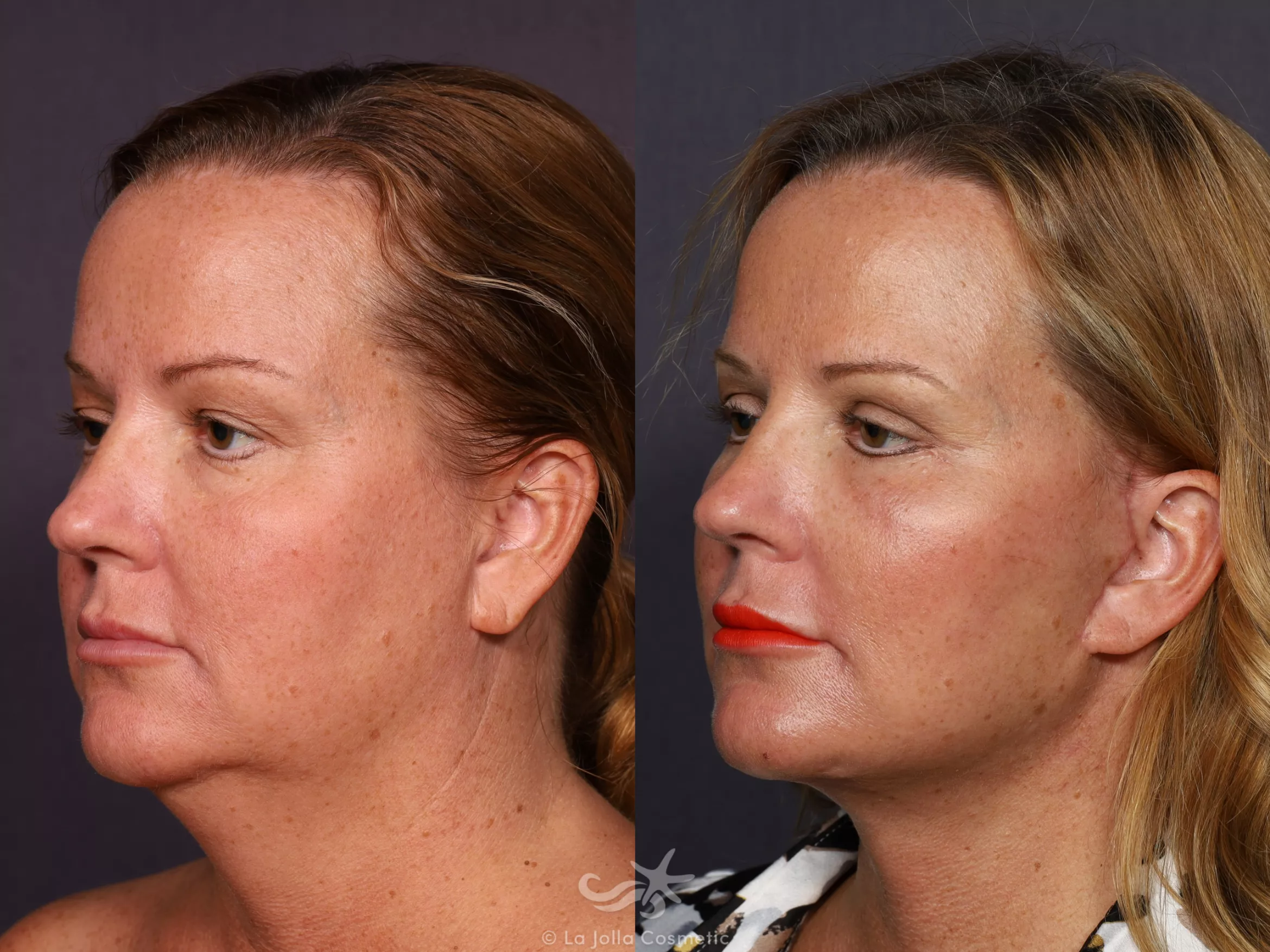 Before & After Facelift Result 725 Left Oblique View in San Diego, CA