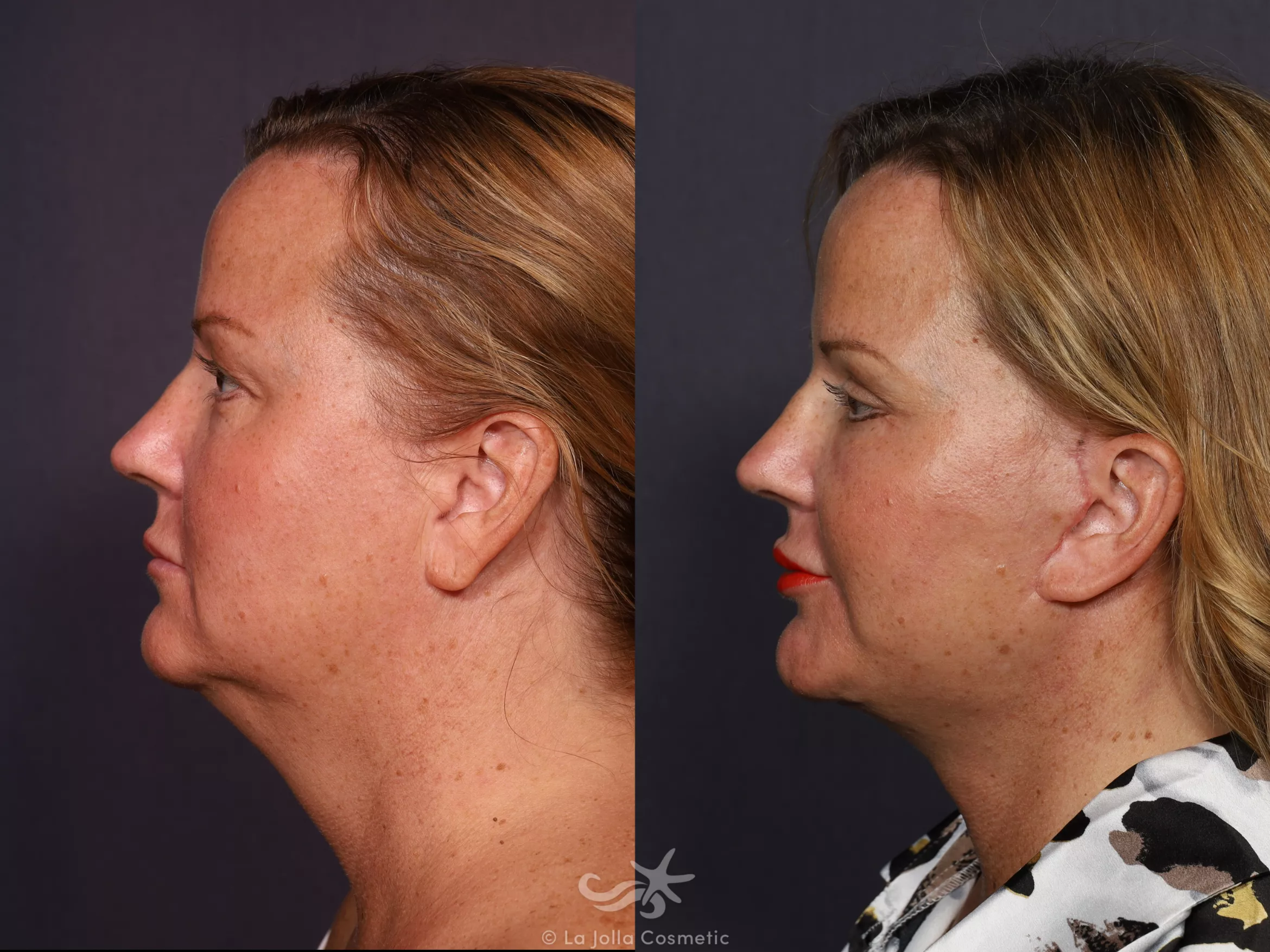 Before & After Facelift Result 725 Left Side View in San Diego, CA