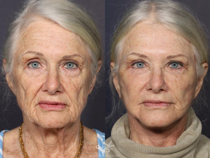 Before & After Neck Lift Result 730 Front View in San Diego, Carlsbad, CA