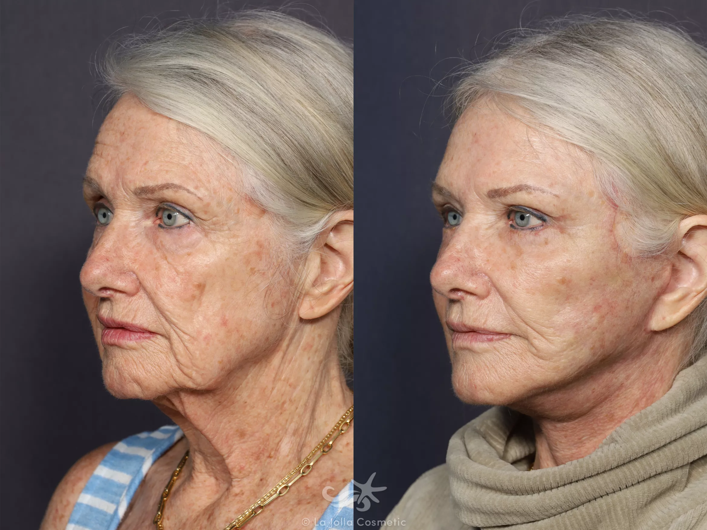 Before & After Facelift Result 730 Left Oblique View in San Diego, CA