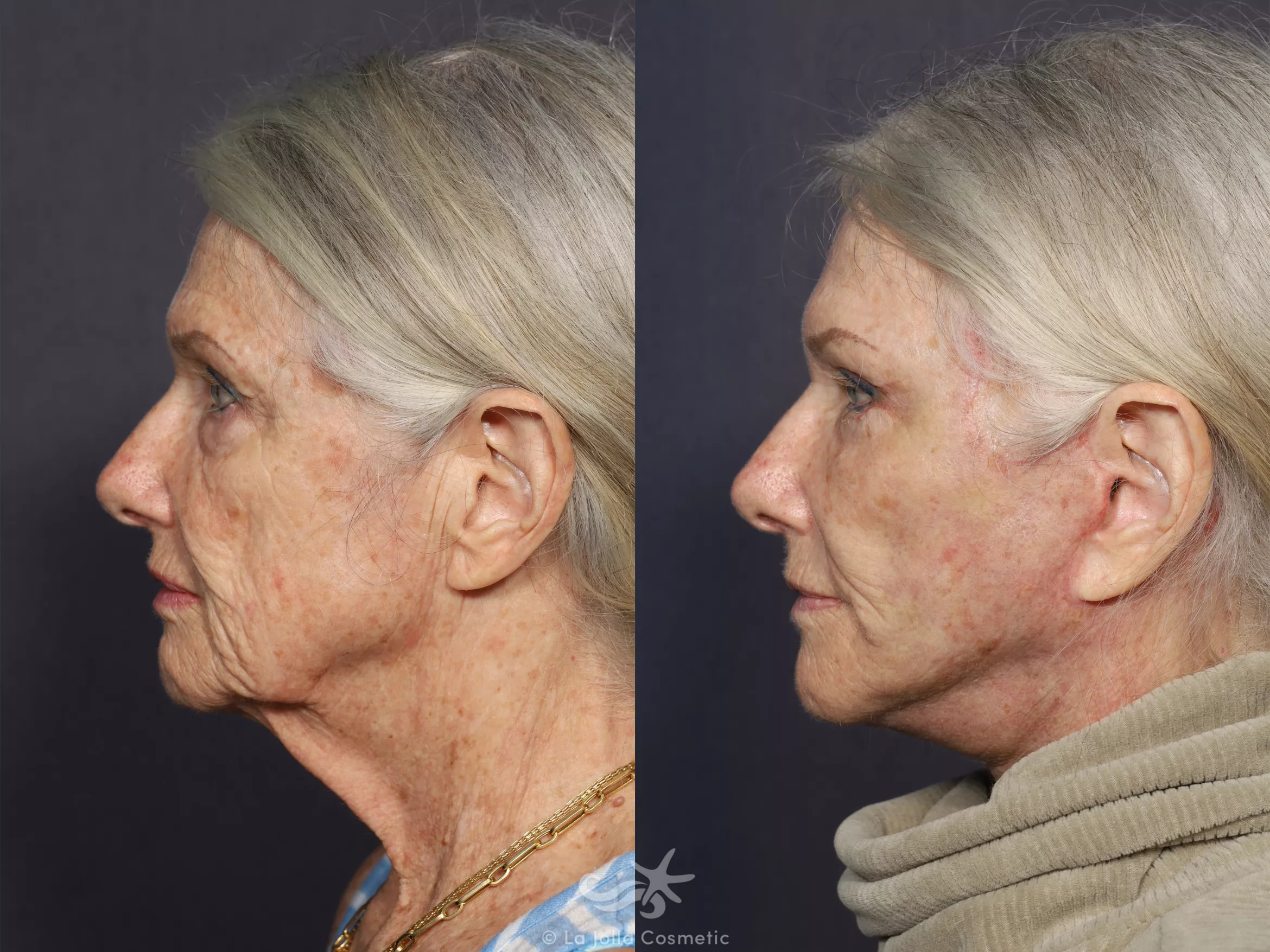 Before & After Facelift Result 730 Left Side View in San Diego, CA