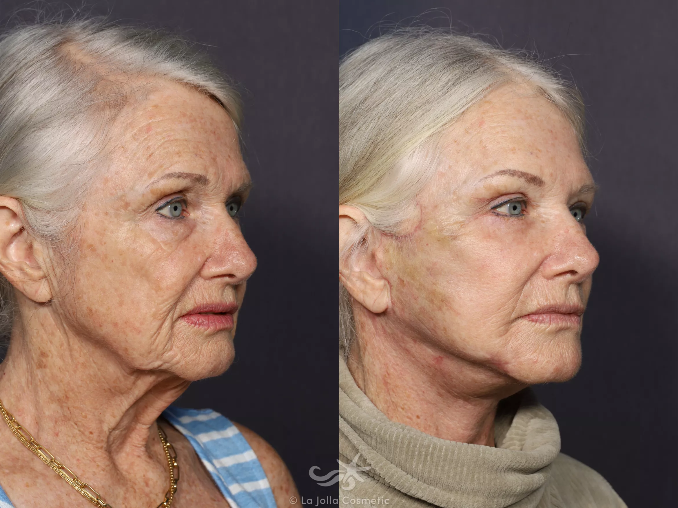 Before & After Facelift Result 730 Right Oblique View in San Diego, CA