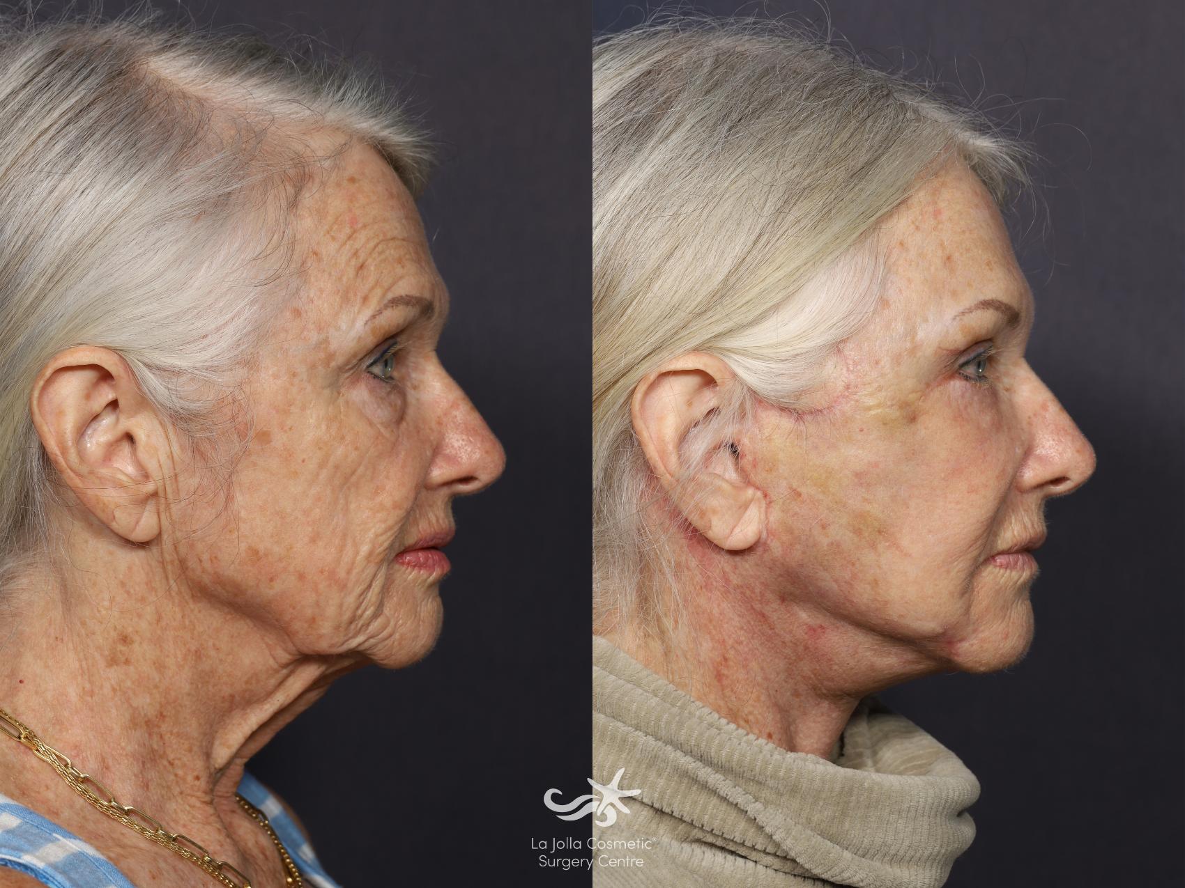 Before & After Facelift Result 730 Right Side View in San Diego, CA