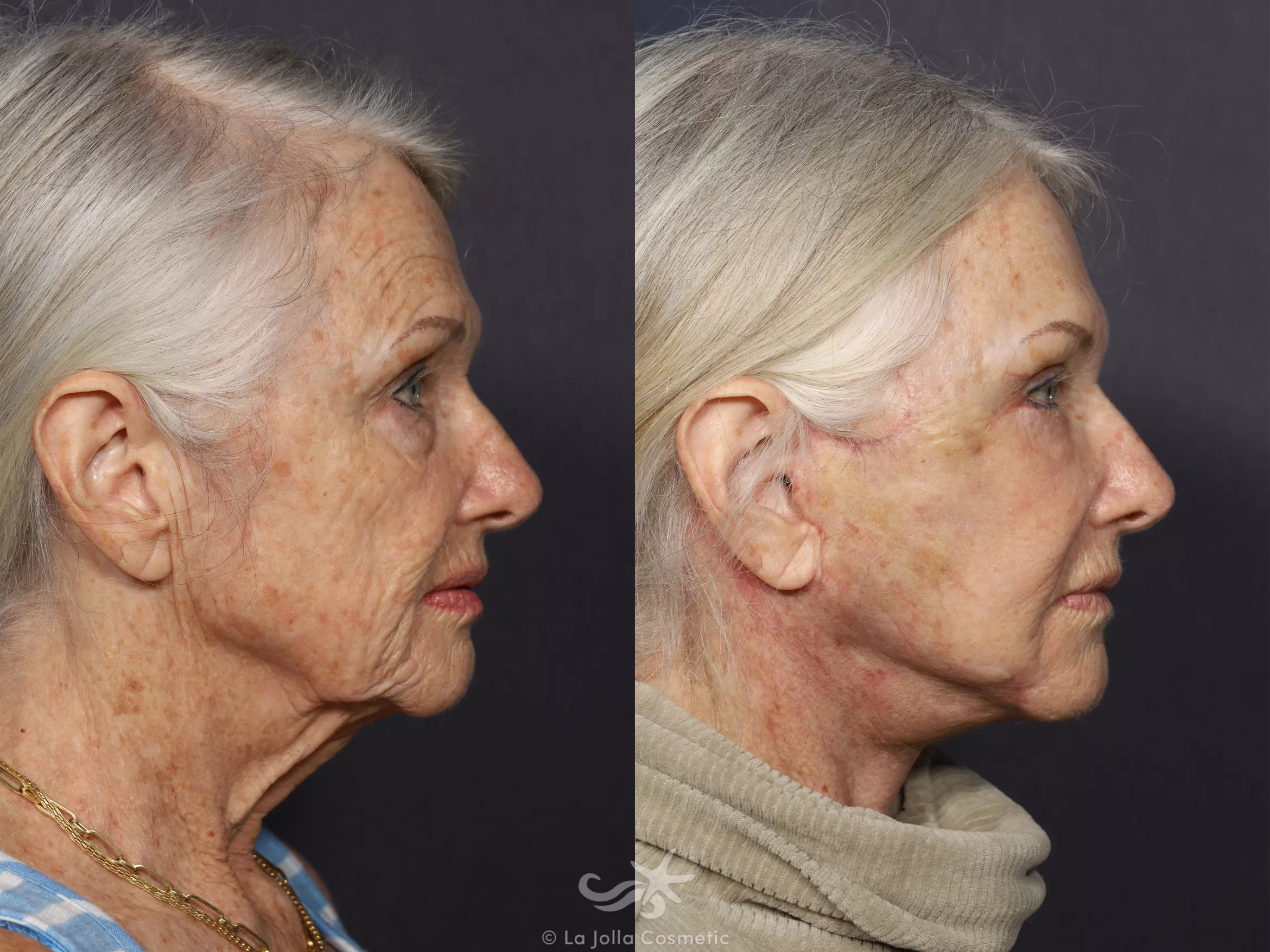 Before & After Facelift Result 730 Right Side View in San Diego, CA