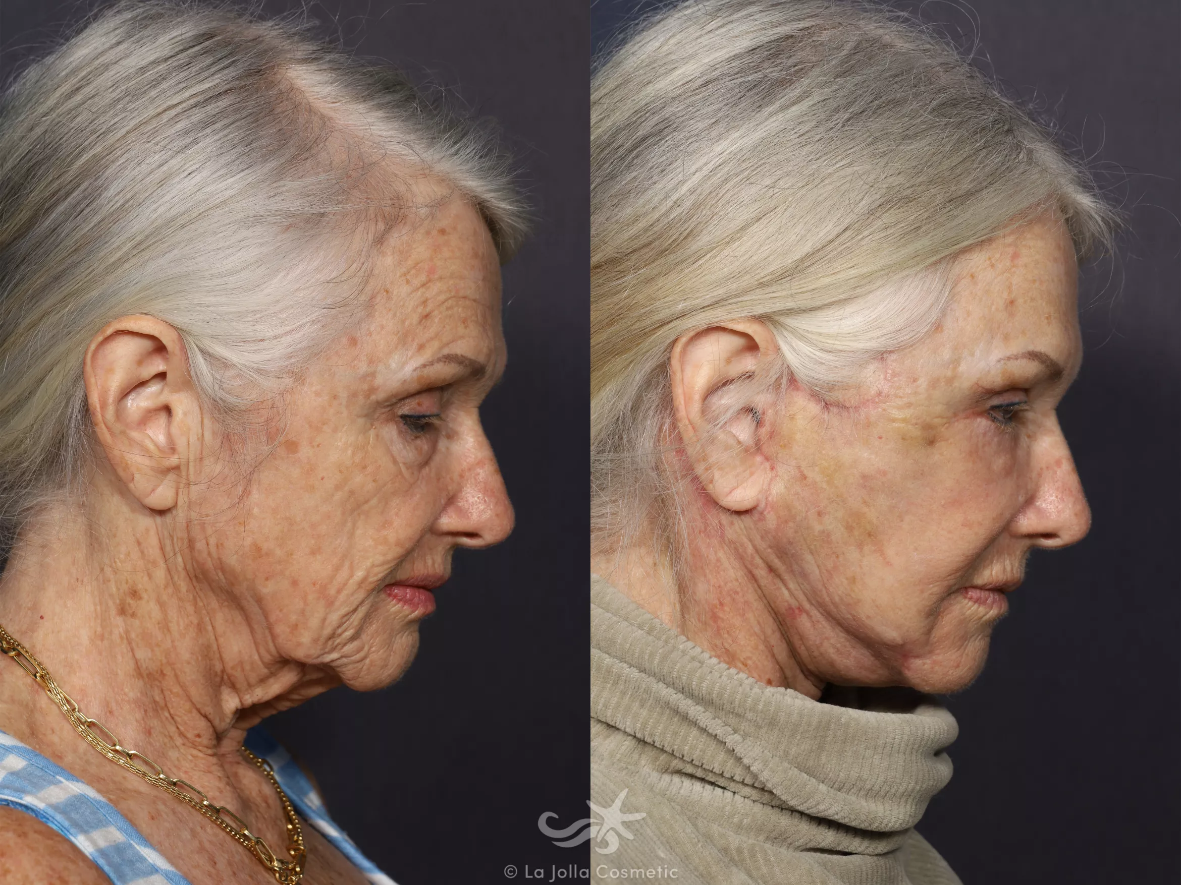 Before & After Facelift Result 730 Right Side Flexion View in San Diego, CA