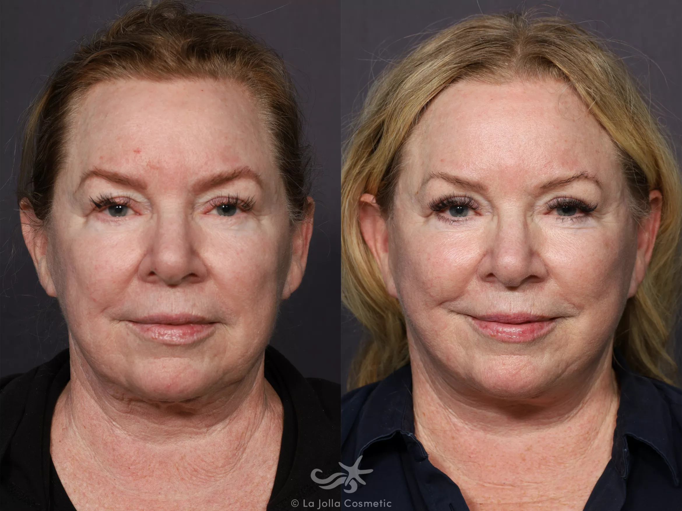 Before & After Facelift Result 737 Front View in San Diego, CA