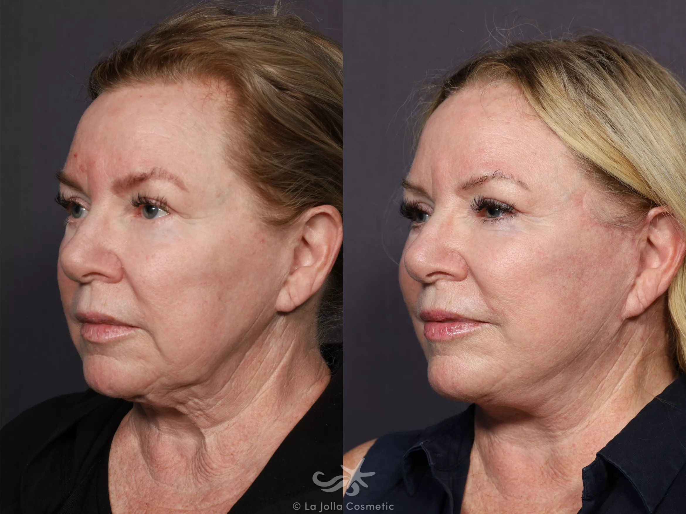 Before & After Facelift Result 737 Left Oblique View in San Diego, CA