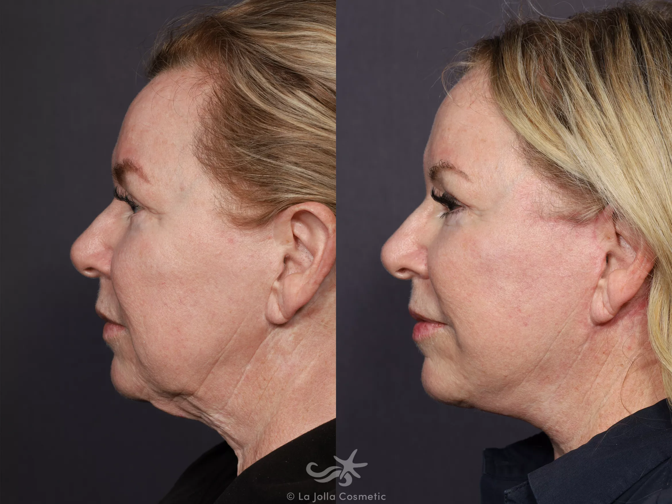 Before & After Facelift Result 737 Left Side View in San Diego, CA