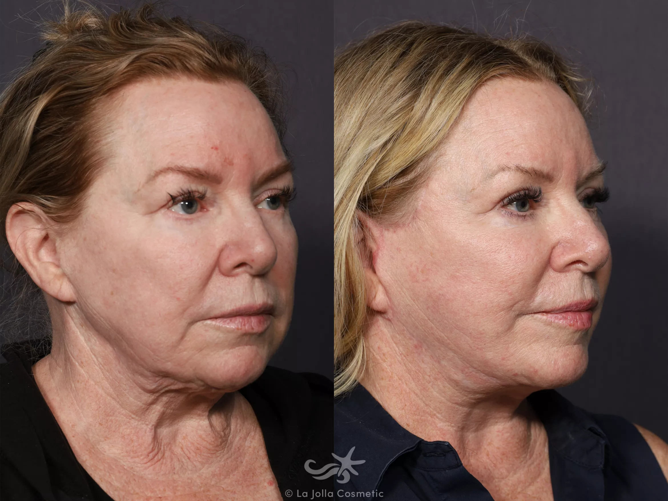 Before & After Facelift Result 737 Right Oblique View in San Diego, CA