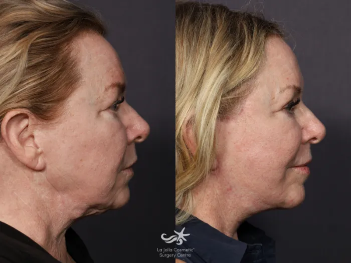 Facelift Before and After Pictures Result 737 | San Diego, CA | La