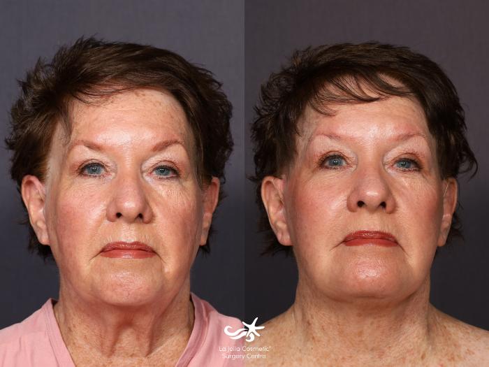 Facelift Before & After Photos: What a Facelift Looks Like at 40, 50, 60 &  70, Facelift in San Diego, CA