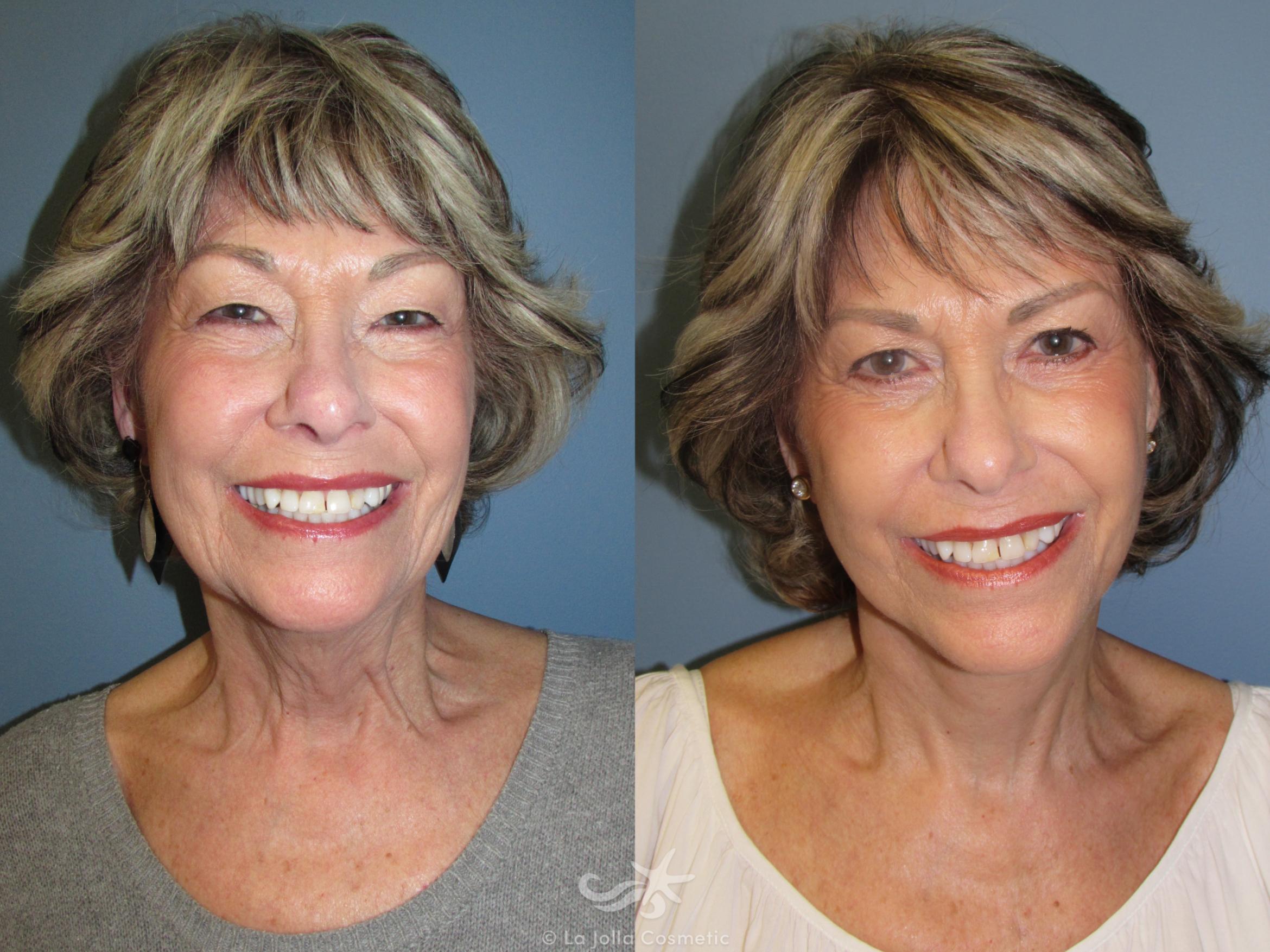 Before & After Facelift Result 800 Front View in San Diego, CA