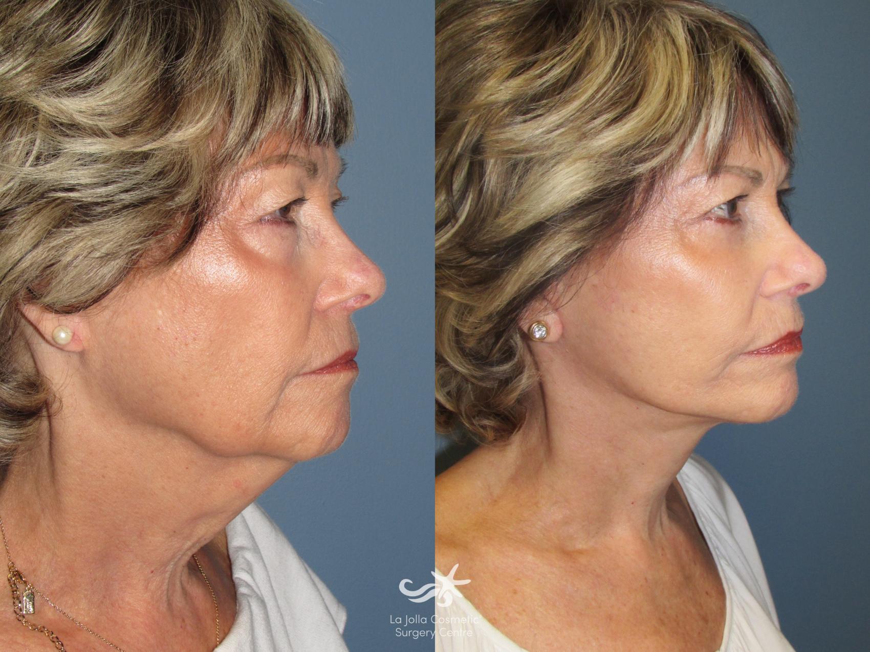 Before & After Facelift Result 800 Right Oblique View in San Diego, CA